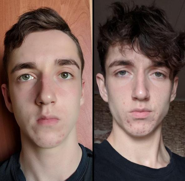 mewing before after result age 17