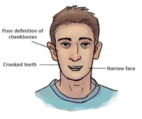 recessed maxilla unattractive face 0