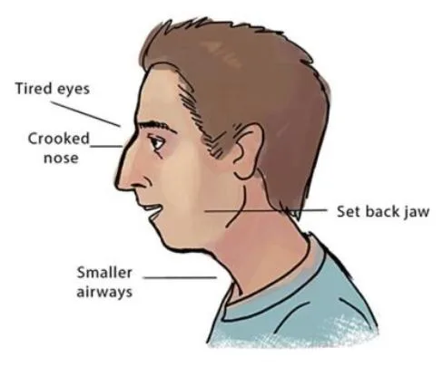 recessed maxilla unattractive face 1