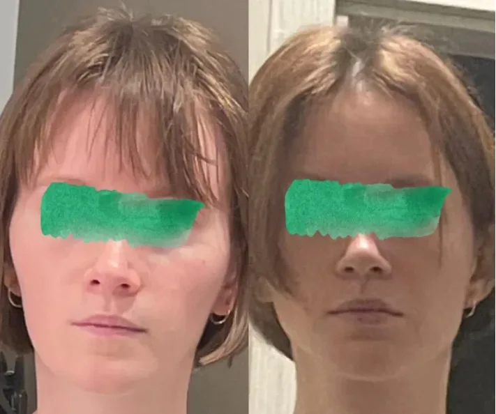 mewing before after female 6