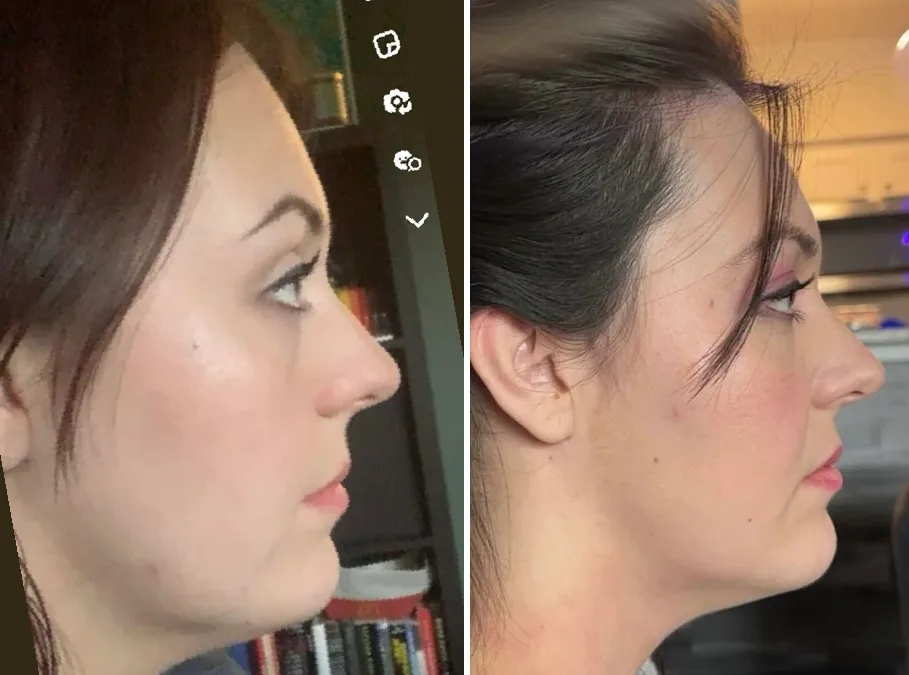 Mewing before and after for females in 2024